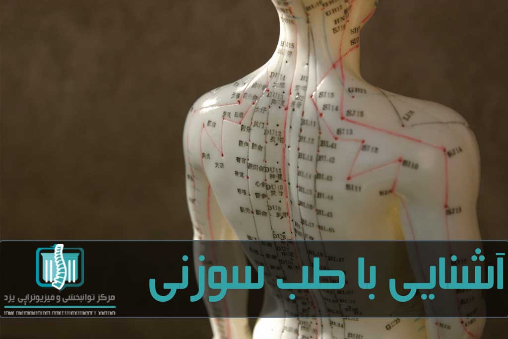 طب سوزنی روش طب سنتی چین است