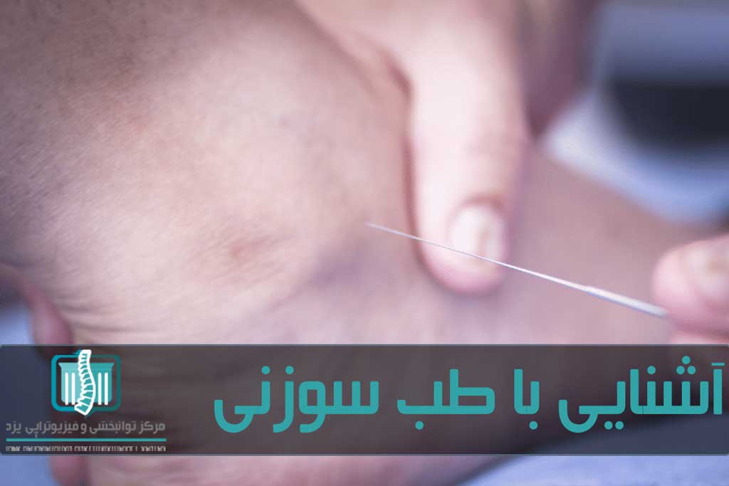 طب سوزنی یا سوزن خشک برای درمان بیماری های اسکلتی عضلانی کاربرد زیادی دارد
