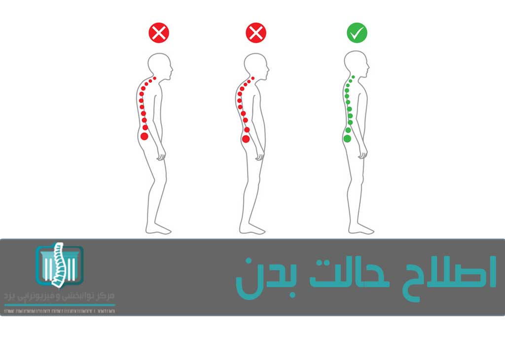 در حالت صحیح بدن، ستون فقرات در شکل طبیعی خود قرار دارد