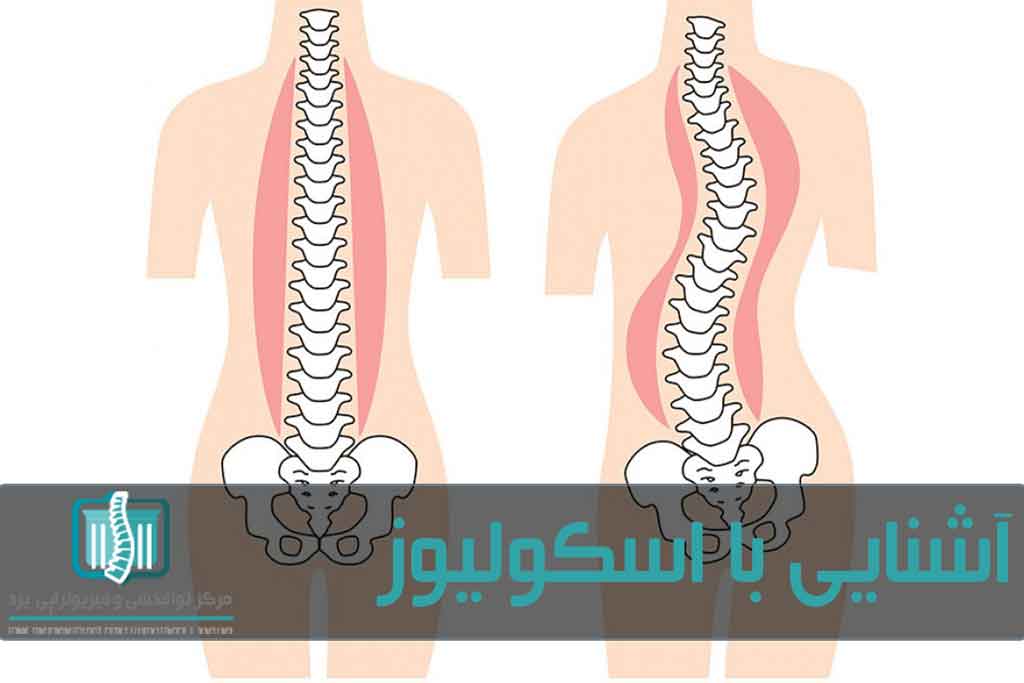اسکولیوز در اثر ایجاد کجی یا انحراف جانبی در ستون فقرات ایجاد می‌شود