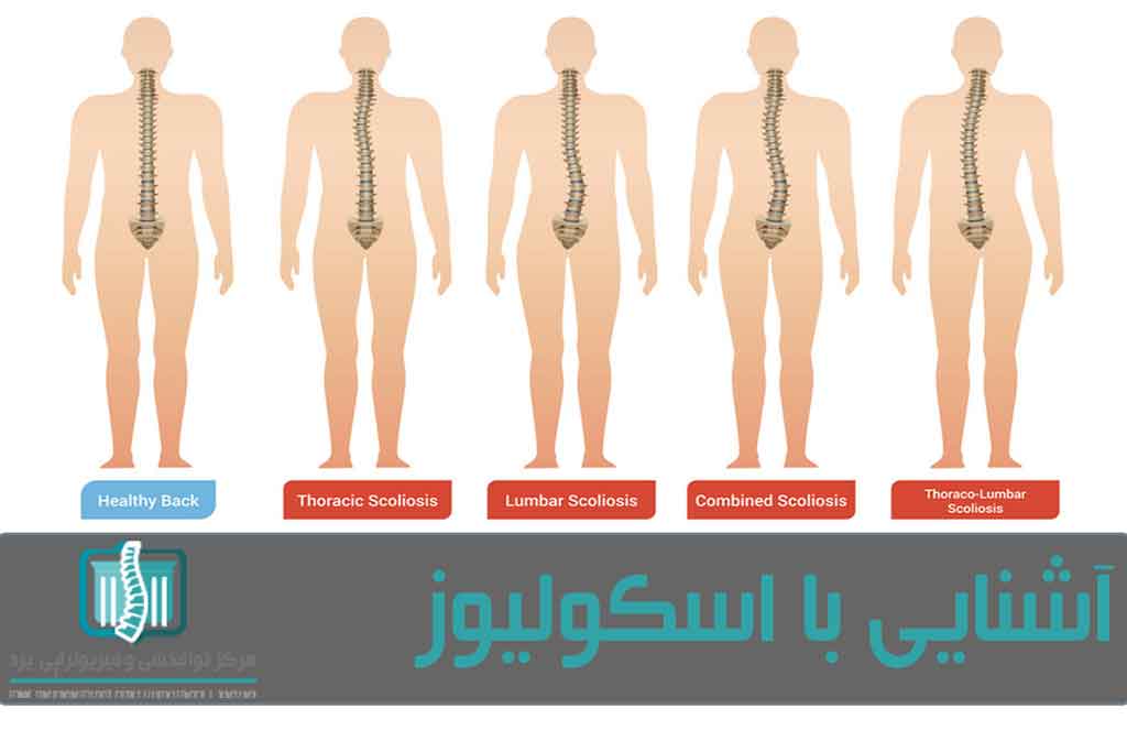 اسکولیوز بر اساس علت ایجاد آن به سه نوع مادرزادی، عصبی و ناشناخته تقسیم می‌شود