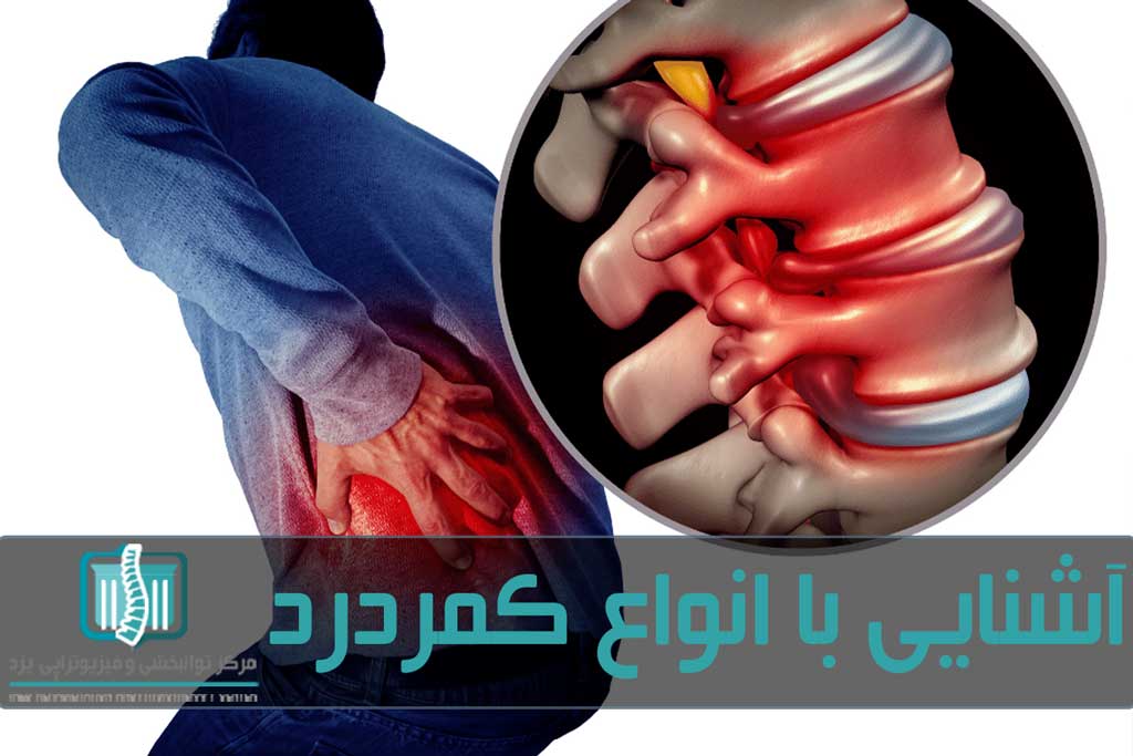 انواع بیماری‌های کمر شامل فتق دیسک کمر، درد سیاتیک، آرتروز و روماتیسم است