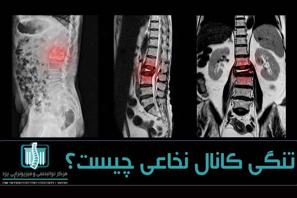 استفاده از آزمایش هایی مثل ام‌آرآی و سی‌تی اسکن برای تشخیص تنگی کانال نخاعی کاربرد دارد