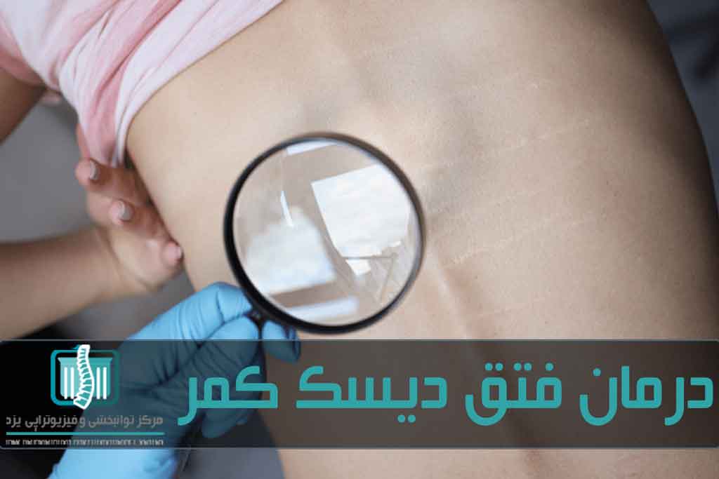 مبتلایان به فتق دیسک کمر باید از ایستادن و راه رفتن خودداری کنند