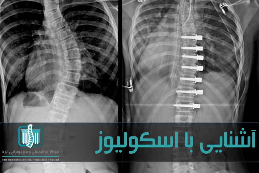 در مواردی که انحراف ستون فقرات روند زندگی بیمار را مختل کرده باشد، ممکن است به عمل جراحی نیاز باشد