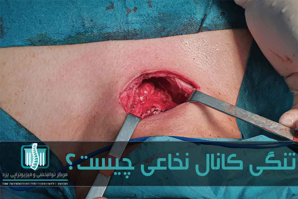 اگر تنگ شدن کانال نخاع باعث اختلال در روند زندگی شود باید برای درمان به عمل جراحی متوسل شد