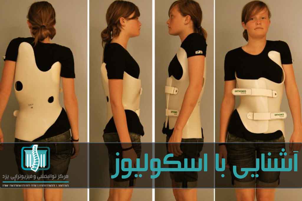 اسکولیوز با روش های فیزیوتراپی و استفاده از بریس قابل درمان است
