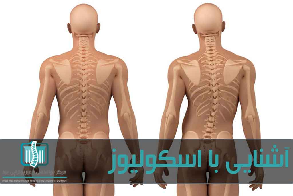 بالاتربودن یکی از شانه‌ها و همتراز نبودن باسن‌ها از علائم انحراف ستون فقرات است