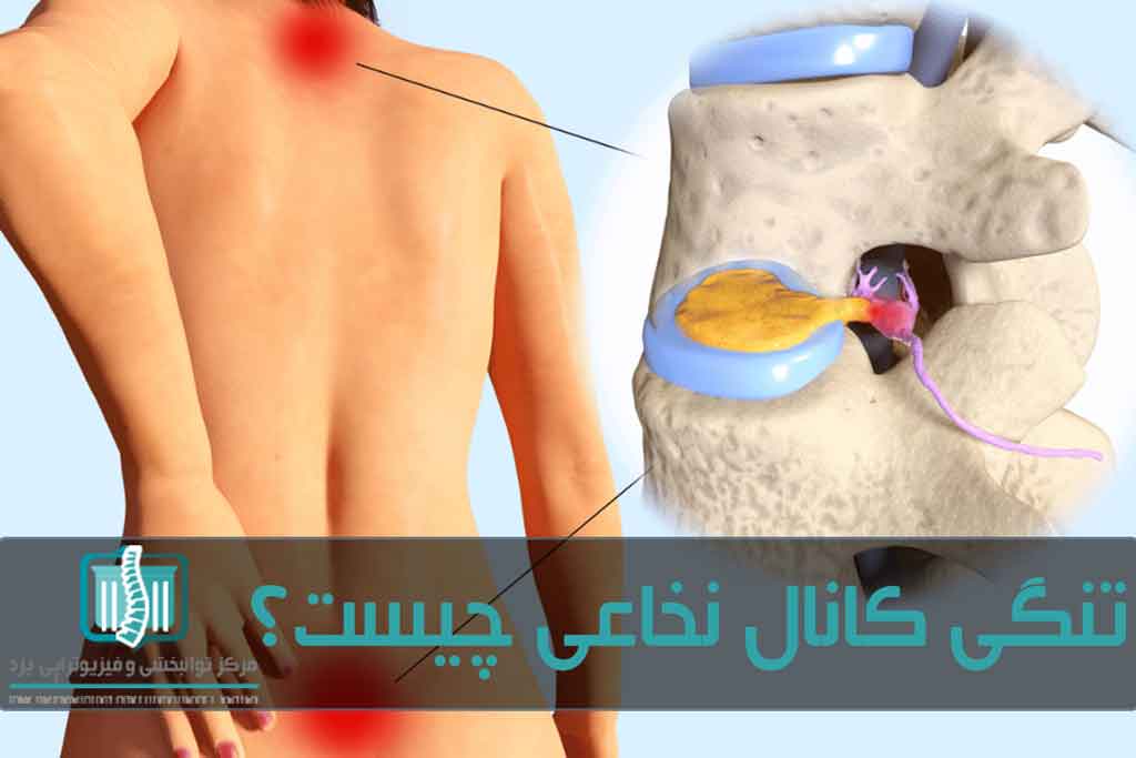 علائم تنگ‌شدن کانال نخاع ممکن است در بالاتنه یا پایین‌تنه بروز پیدا کند