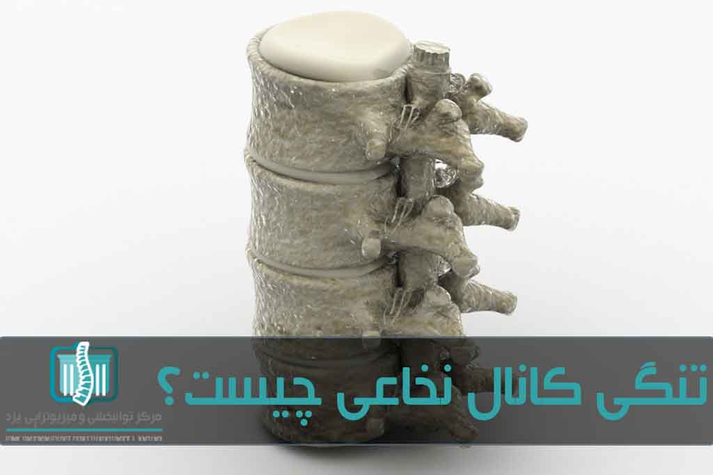 بالارفتن سن، شکستگی و بیماری‌هایی مثل آرتروز علت تنگ شدن محل عبور نخاع هستند