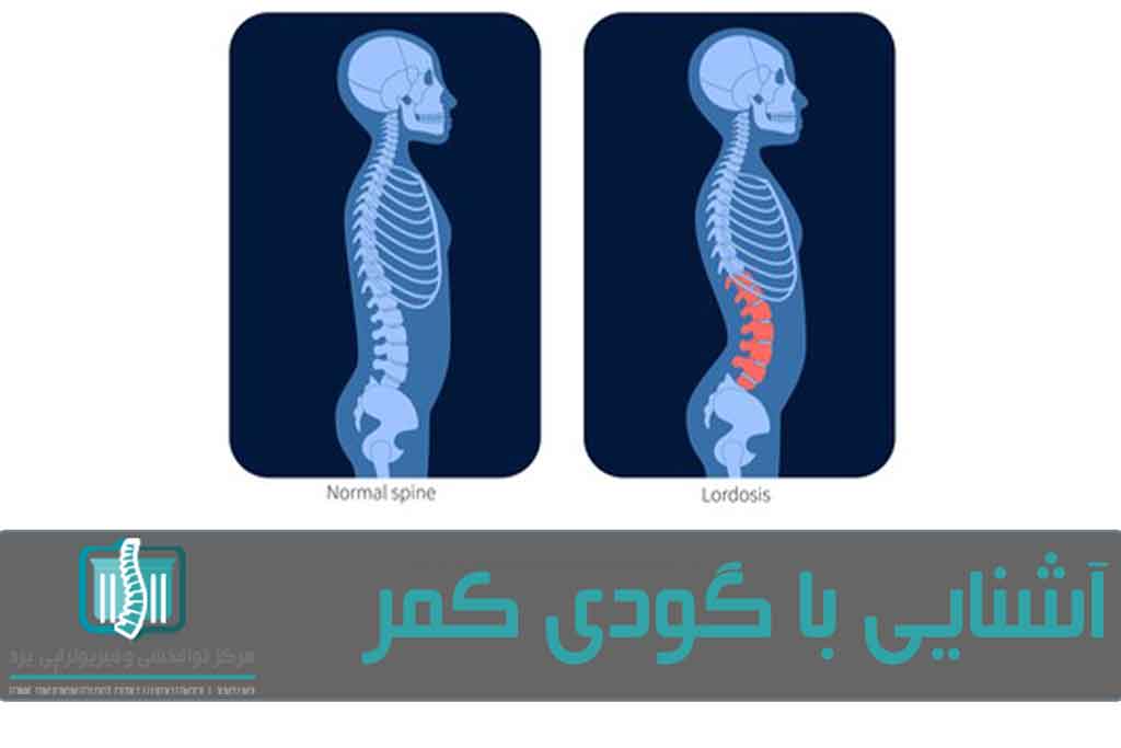 علت بروز لوردوز، بیماری‌های زمینه‌ای یا رعایت‌نکردن حالت صحیح بدن است