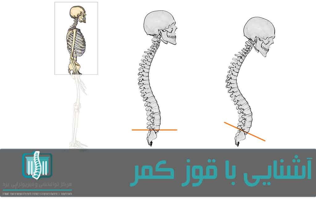 قوز کمر یا کیفوز در اثر زیادشدن انحنای قسمت سینه‌ای ستون فقرات ایجاد می‌شود