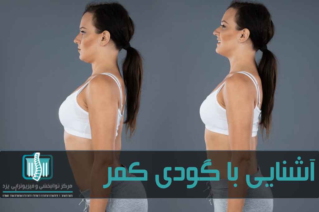 زیاد شدن انحنای کمری ستون فقرات اصطلاحا باعث گودشدن کمر می‌شود