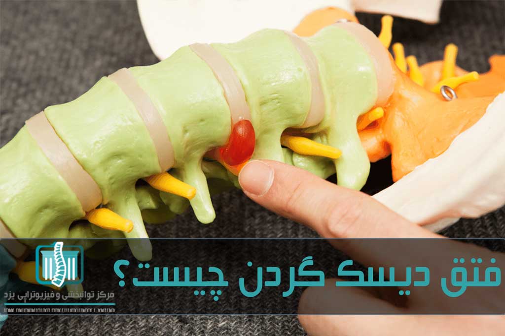 آسیب دیسک گردن در دو حالت بیرون‌زدگی یا پارگی اتفاق می‌افتد