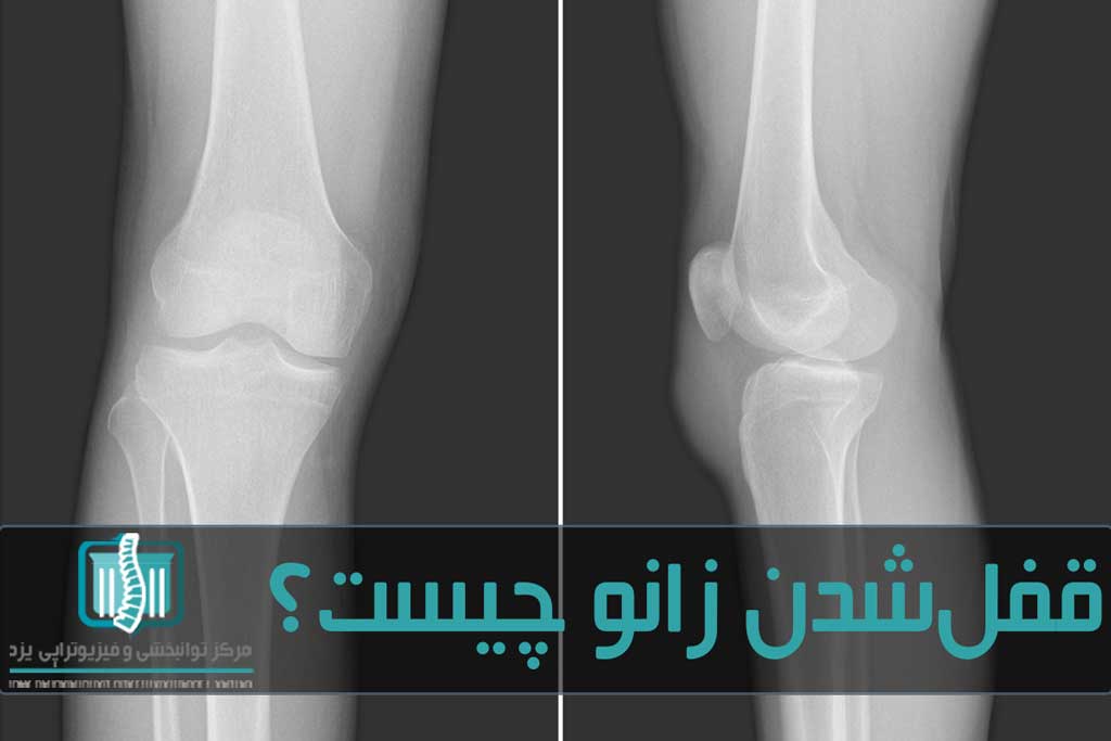 با استفاده از ارزیابی فیزیکی و آزمایش‌های تصویربرداری مشکلات زانو تشخیص داده می‌شود