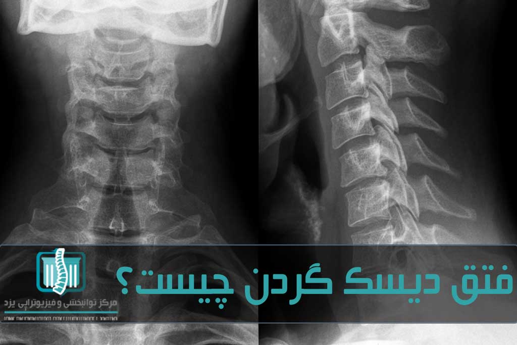 عمل جراحی به ندرت برای گردن استفاده می‌شود