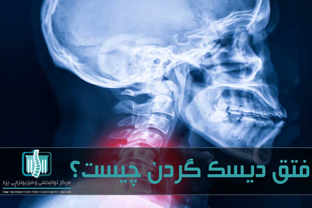 اگر دیسک ها به نخاع فشار بیاورند خطرناک است