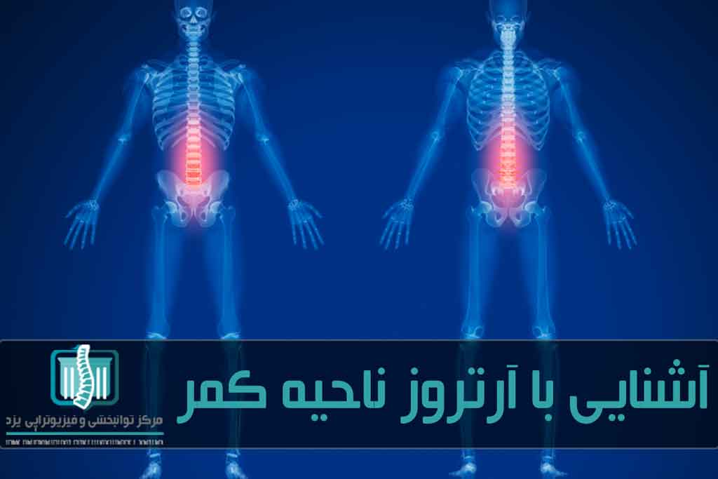 داروهای ضدالتهاب و روش‌های فیزیوتراپی برای کاهش علائم آرتروز در ستون فقرات استفاده می‌شود