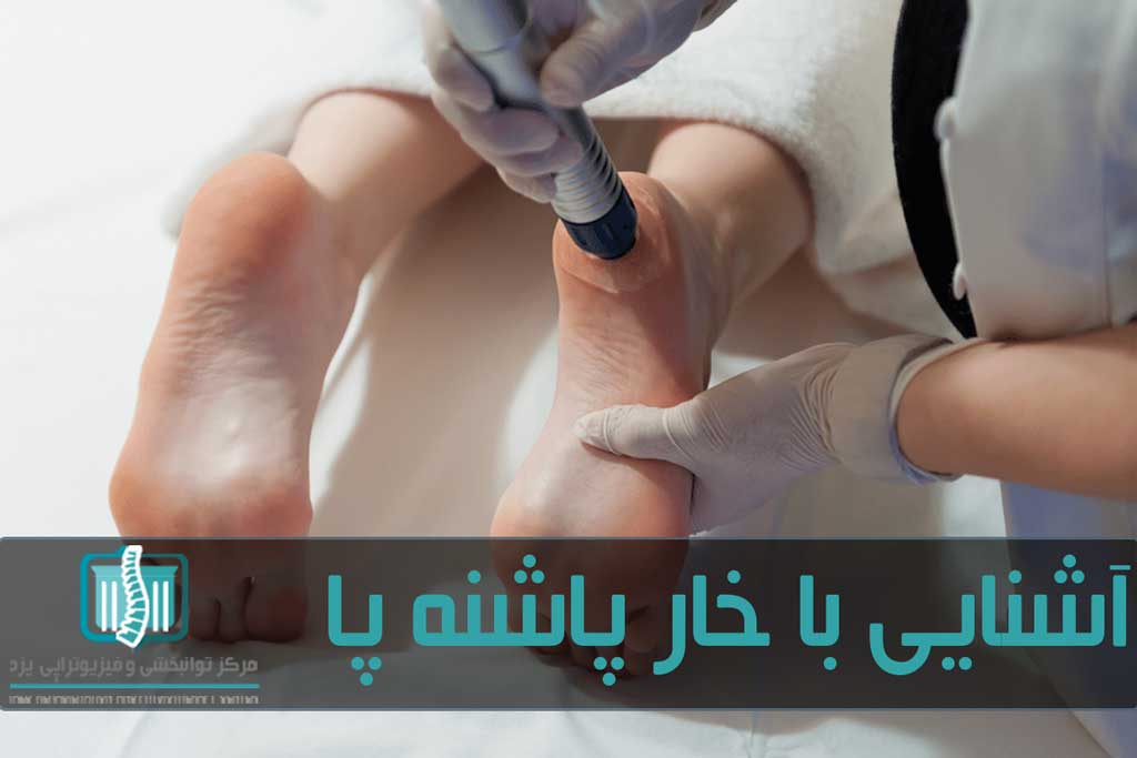 با استفاده از روش‌های فیزیوتراپی می‌توان به درمان خار پاشنه پا پرداخت