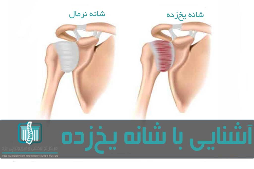 ئر اثر بروز التهاب و ضخیم شدن کپسول شانه، حرکات شانه به شدت محدود می‌شود