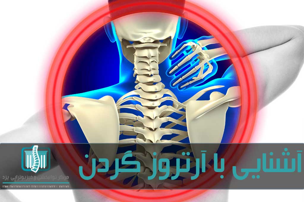 درد و گرفتگی در ناحیه گردن و احساس صدای ساییدگی هنگام چرخاندن سر از علائم بروز اسپوندلوزیس است