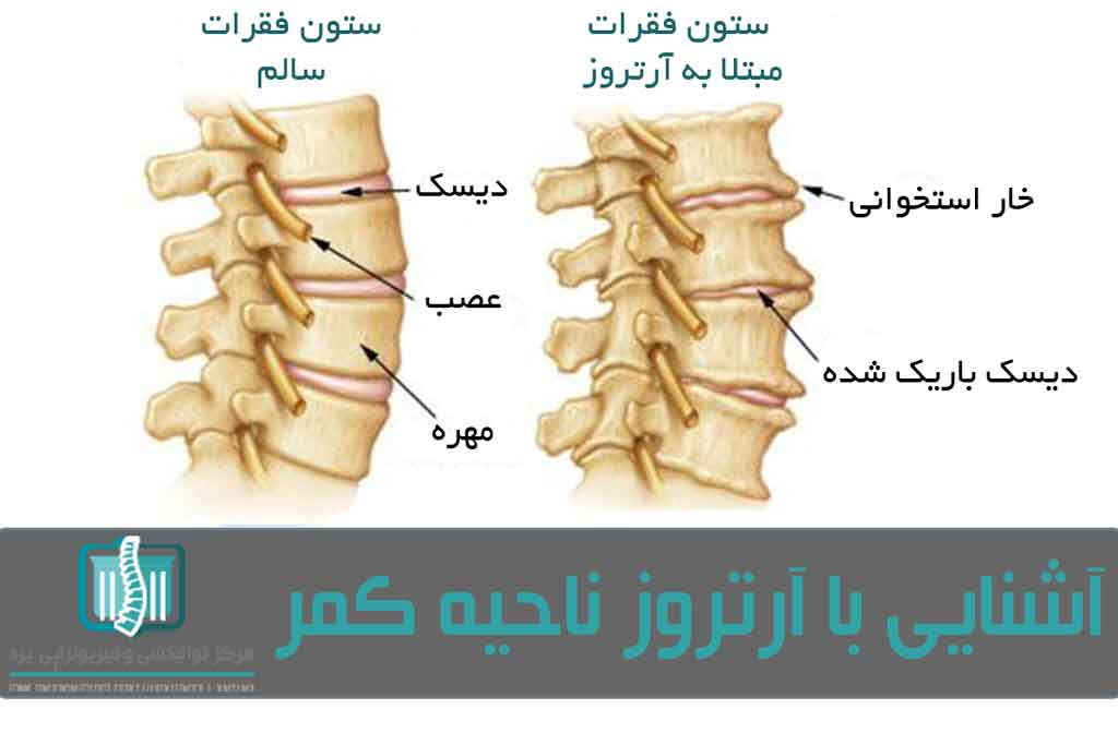 تحلیل رفتن غضروف‌ها و ساییدگی مفصل از علل بروز آرتروز در کمر به حساب می‌آید