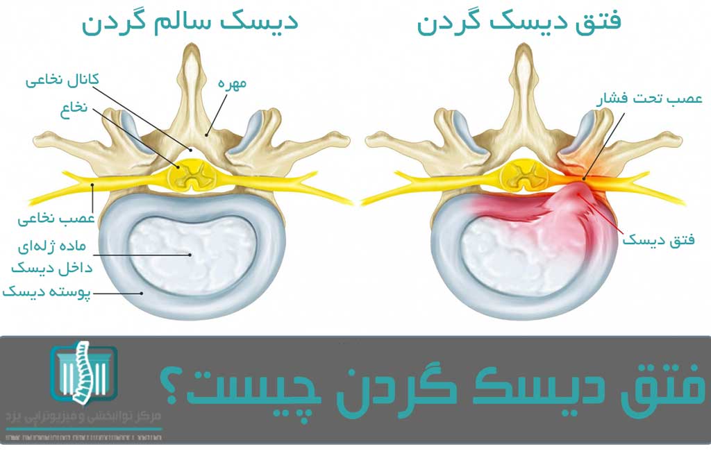 دیسک ها در ستون فقرات گردن نقش کمک فنر را دارند