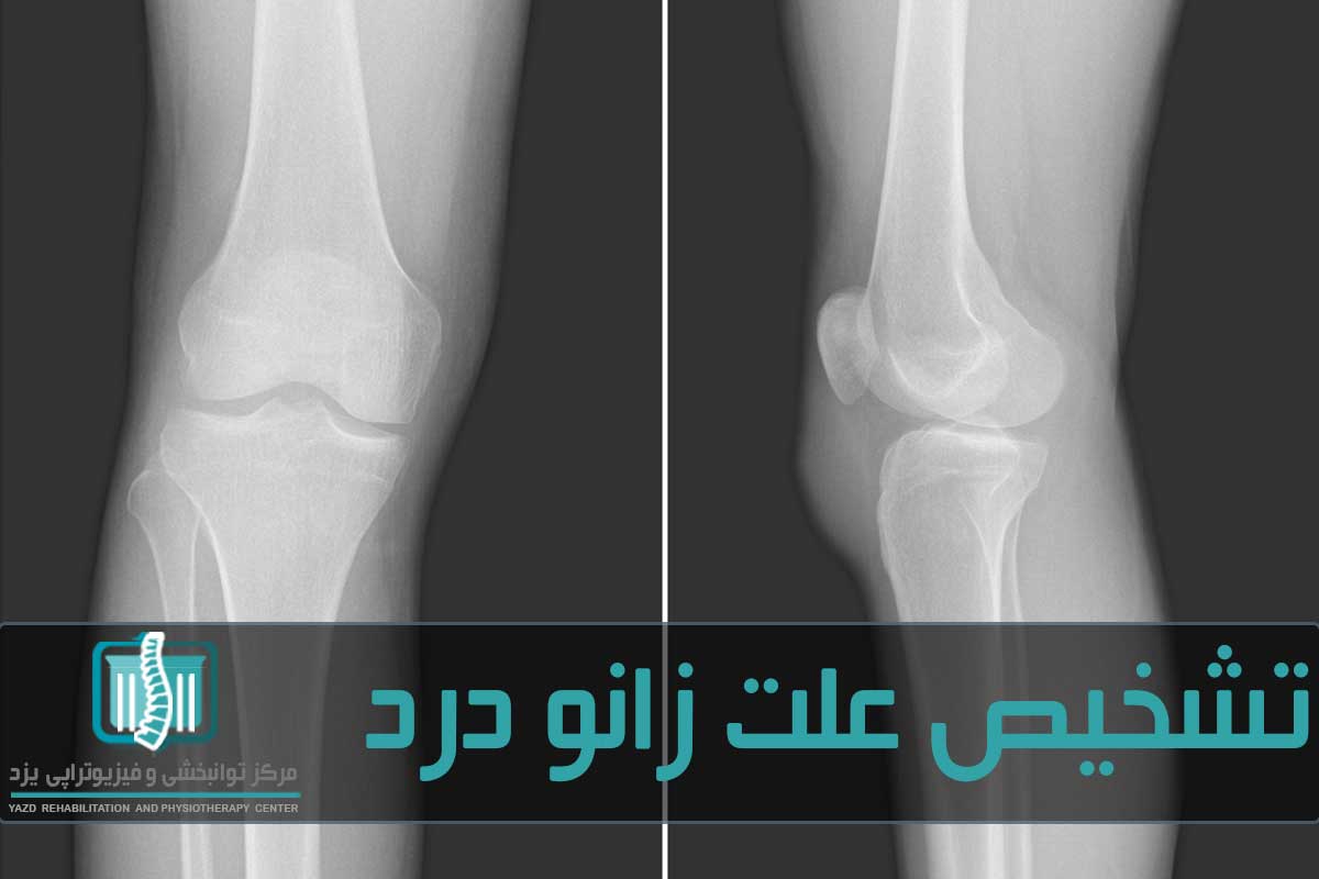 برای تشخیص علت زانو درد از رادیولوژی و سی تی اسکن استفاده می‌شود